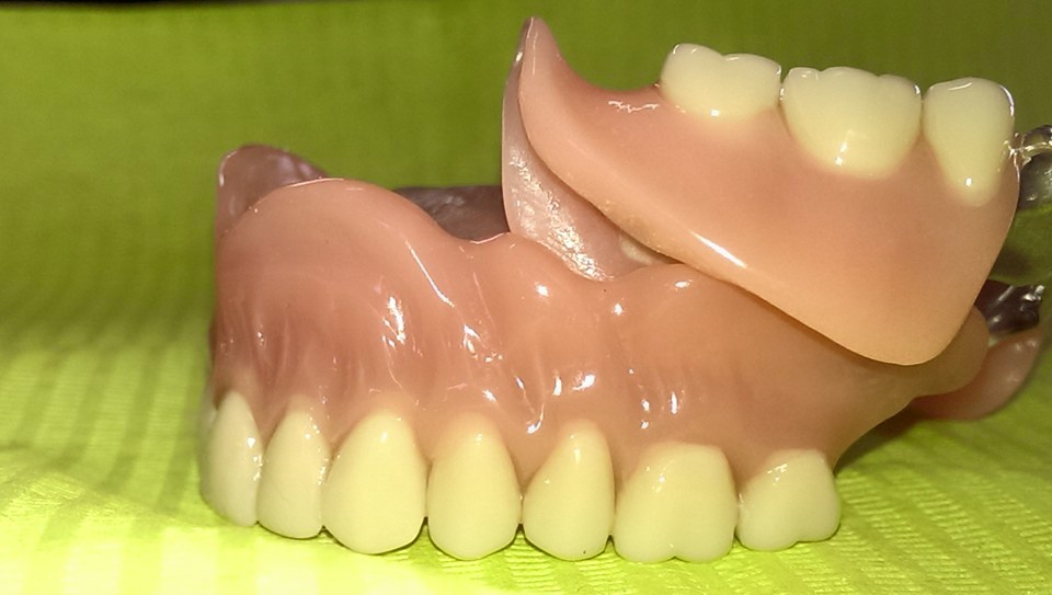esempio di dentiera completa